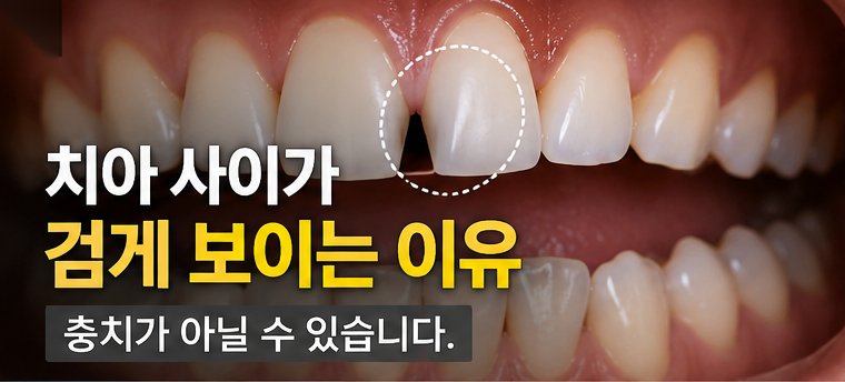 웃을 때 보이는 검은 삼각형