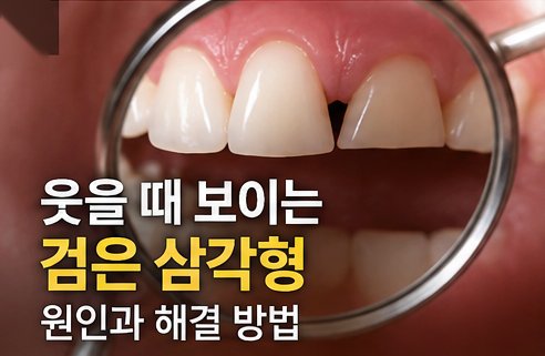 잇몸이 내려가면 치아 사이가 검게 보인다